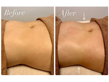 リブ(LIB)/WINBACK ビフォーアフター