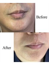 ライチェンド(Reizend)/ヒゲ脱毛