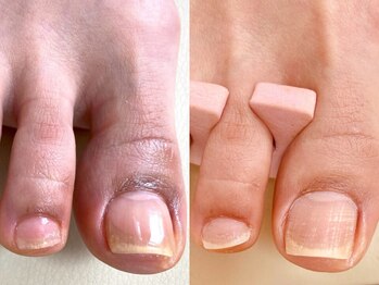 ネイルスペース モア ナープスの写真/フットジェルだけでなく、巻き爪でお悩みの方のメニュー【巻き爪緩和ケア】もご用意しております♪