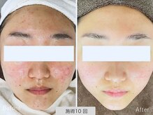 ニキビ研究所 千葉店/10代のニキビもお任せ！