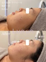 ルノン(Lunon)/毛穴洗浄ハイドロ×ララピール