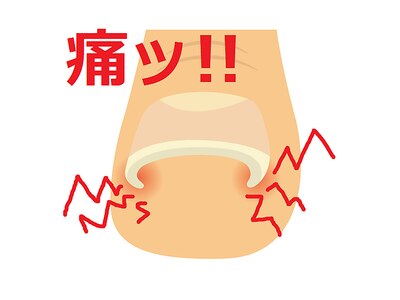 巻き爪の方！当店へ！！一緒に改善しましょう☆