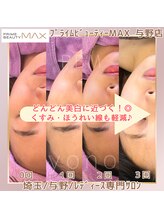 マックス 与野店(MAX)/安定的な効果！/与野大宮うなじ