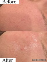 ウォーム(Warm)/20代　毛穴エクストラクション