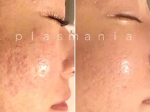 エレグラム(Elegram)/プラズマニア　施術