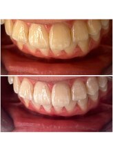 エクシアホワイトニング 代々木店/ホワイトニングビフォーアフター