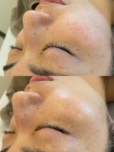 シュシュ(Chou Chou)/☆ハーバルメソッド☆¥11,000