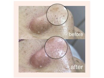 サロン ド ソワン(salon de soin)/毛穴エクストラクション