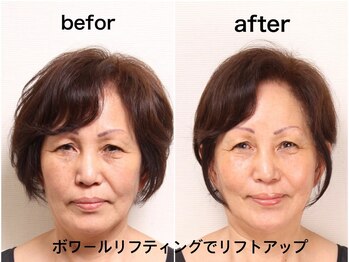 アンジュマリー/☆目の周りのたるみ改善に☆