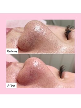 ホワイトラボ ライカム前店(White labo)/【施術例】毛穴洗浄ピーリング