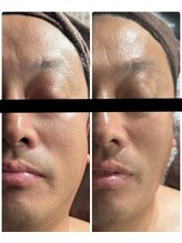 ハル(陽 HARU)/男性の方にも幹細胞美容が人気♪