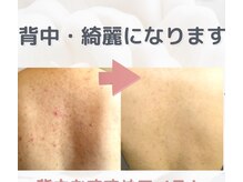 ビビ(VIVI)/ハーブピーリング背中ニキビケア