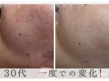 アルム(Areum)/今できてるニキビにも◎