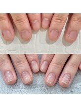 リファーレ(RIFARE)/深爪矯正4ヶ月後