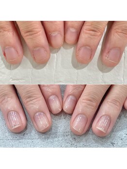 リファーレ(RIFARE)/深爪矯正4ヶ月後