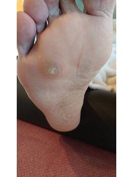 フットケアサロン ラビフット(Rabbi foot)/痛い魚の目、我慢しないで！