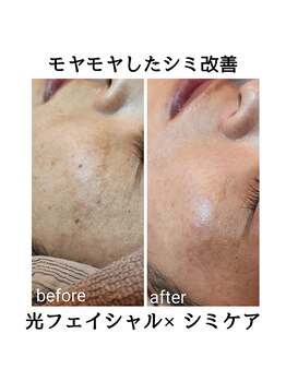 ルオント(LUONTO)/光フェイシャル×シミケア症例