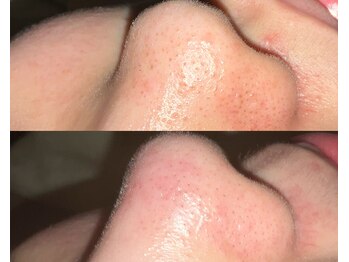 ル シーニュ/毛穴エクストラクション