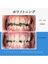 ホワイト 金沢店/一回でも効果でます！