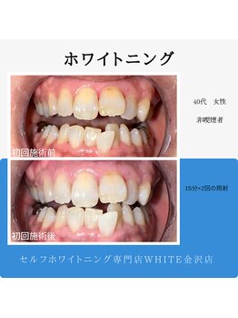 ホワイト 金沢店/一回でも効果でます！