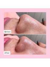 ホワイトラボ ライカム前店(White labo)/【施術例】毛穴洗浄ピーリング