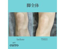 アクト クロ(ACT curro)/【脚全体】脱毛施術例