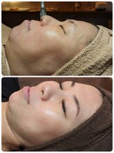 ウララ(ulala)/韓国ピーリング/初回と10回目