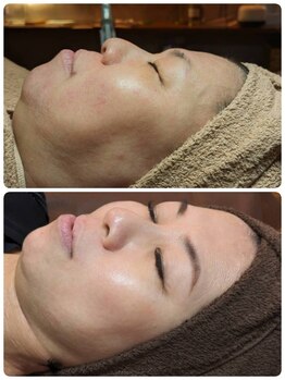 ウララ(ulala)/韓国ピーリング/初回と10回目