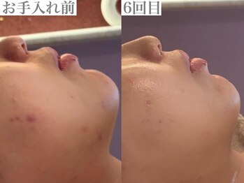 シーン(Sheen)/繰り返す大人ニキビ