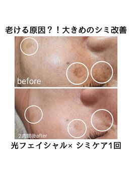 ルオント(LUONTO)/光フェイシャル/シミケア症例