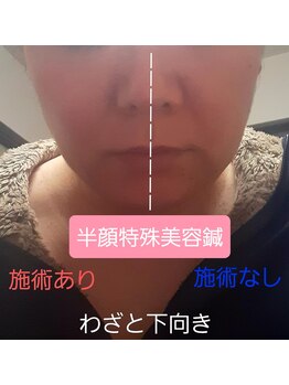 エルアンドエス(L&S)/半顔特殊美容鍼