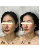 アディス 心斎橋(ADISE)/フェイスラインすっきり♪