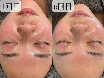 サロンドエテ(salon de ete)/肌悩み改善ハーブピーリング