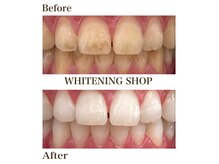 ホワイトニングショップ 恵比寿店の雰囲気（☆before＆after★）