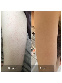 モカ 天王寺店(MOKA)/毛穴ケア　ニキビケア　しみケア