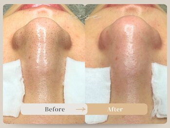 トネア 自由が丘店の写真/長年の毛穴・お肌悩みを根本から解決!素肌に自信がつく毛穴・肌質改善を、ぜひ一度ご体験ください★