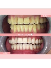 エクシアホワイトニング 札幌琴似店/ホワイトニングビフォーアフター