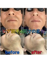ホーミーズ 燕三条(HOMIES)/ヒゲ脱毛4回の変化