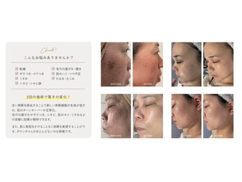 デラッセ サロン ギンザ 藤枝店(Delasser salon GINZA)/韓国iLLON &nbsp;剥離ピーリング