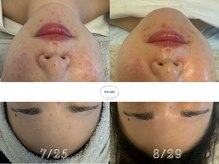 スワン 大阪南堀江(swan)/水分不足の乾燥肌にお悩みの方