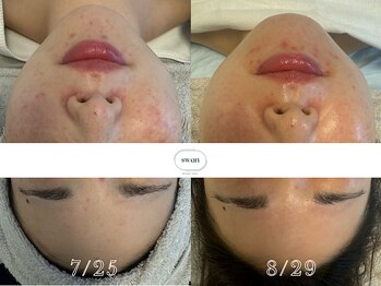 スワン 大阪南堀江(swan)/水分不足の乾燥肌にお悩みの方