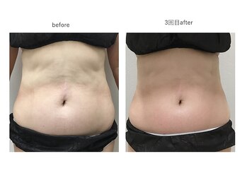 ルミエール(Rumiere)/ウィンバックボディー施術