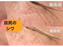 ルアーナ(Luana)/目尻のしわケアハーブピーリング