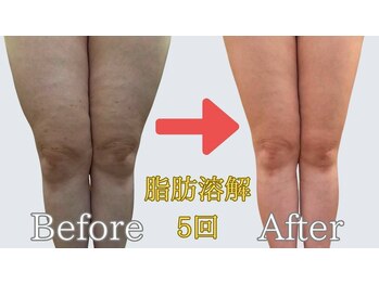 エステサロン 美飾り イオンモール木更津店/before⇒after/脂肪分解注入