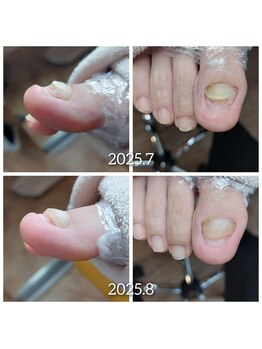 【爪甲の肥厚・変形】