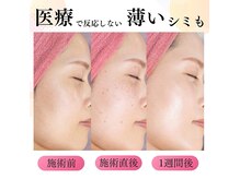レーザーで限界といわれた薄いシミもお任せ♪