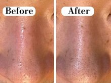 ビースキン 広島(BE:SKIN)/毛穴洗浄/ハーブピーリング