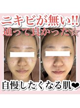 ホワイトアクア 梅田本店(WHITE AQUA)/ハーブピーリング/大阪/梅田