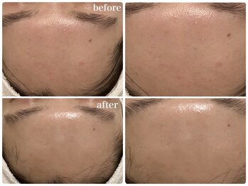 リリィブラン(Lily branc)/毛穴ニキビケア/ピーリング