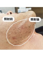 メンズー(MENZOO)/【お客様写真】ヒゲ脱毛